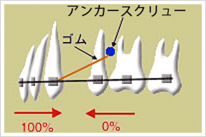 ミニインプラント2