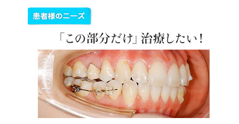 「この部分だけ」治療したい！